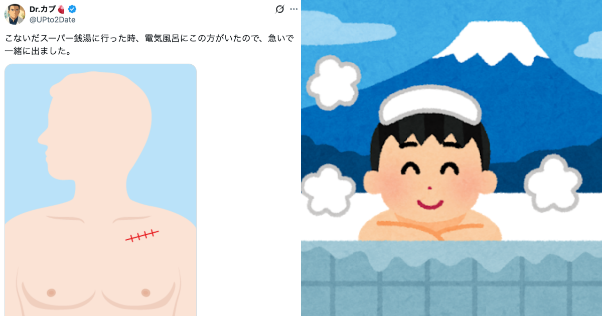 Doctor Spots Suspicious Scar in Public Bath, Saves Man from Potential Tragedy – Netizens Call Him a "Bathhouse Superhero"